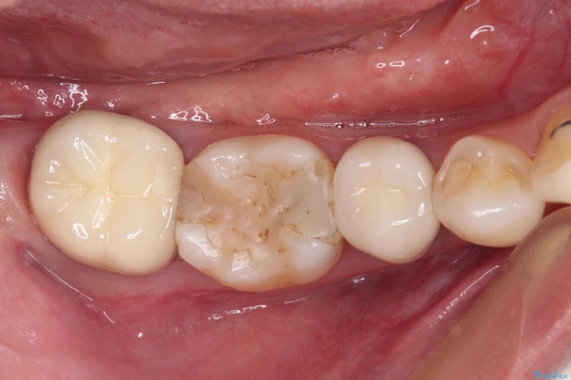 奥歯がしみる　色々な国で治療を受けてきた奥歯のむし歯治療 治療前