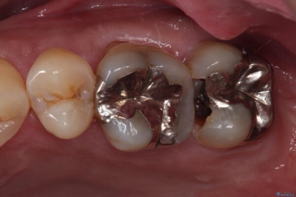 歯に穴が空いてしみる　ものが挟まってしまうほど大きな奥歯のむし歯 治療前画像