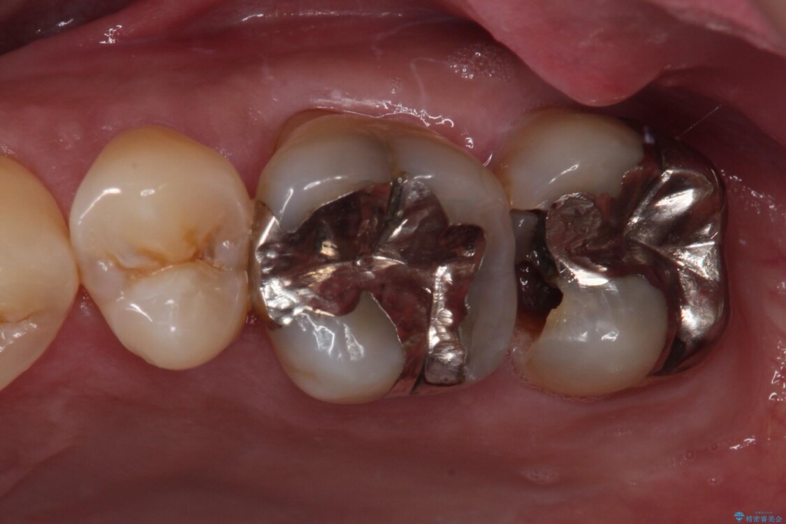 歯に穴が空いてしみる　ものが挟まってしまうほど大きな奥歯のむし歯 治療前