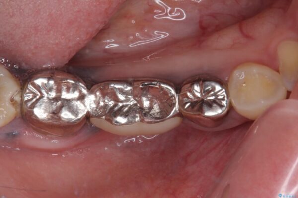 痛む奥歯　目立つ銀色の奥歯をセラミックに　セラミックブリッジ 治療前画像