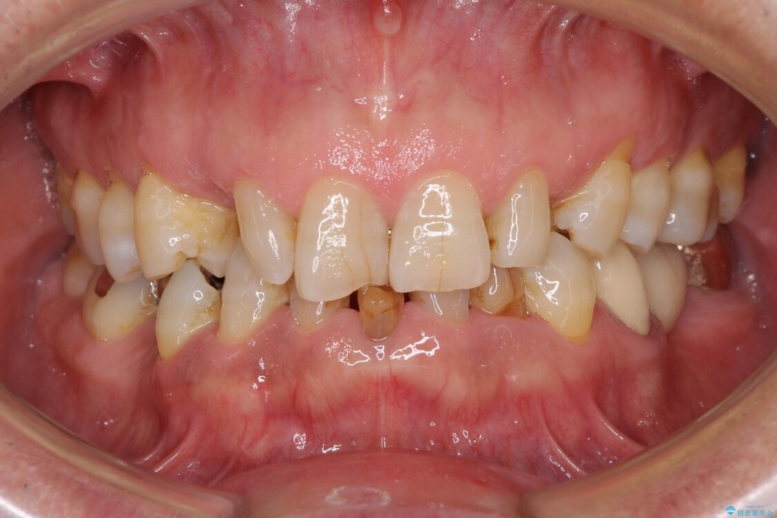 乳歯や矮小歯の多い前歯　部分矯正と補綴治療による審美歯科治療 治療前