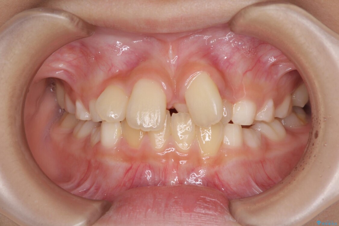 過剰歯を抜歯して前歯を排列　インビザライン・ファーストによる小学生のⅠ期治療 治療前
