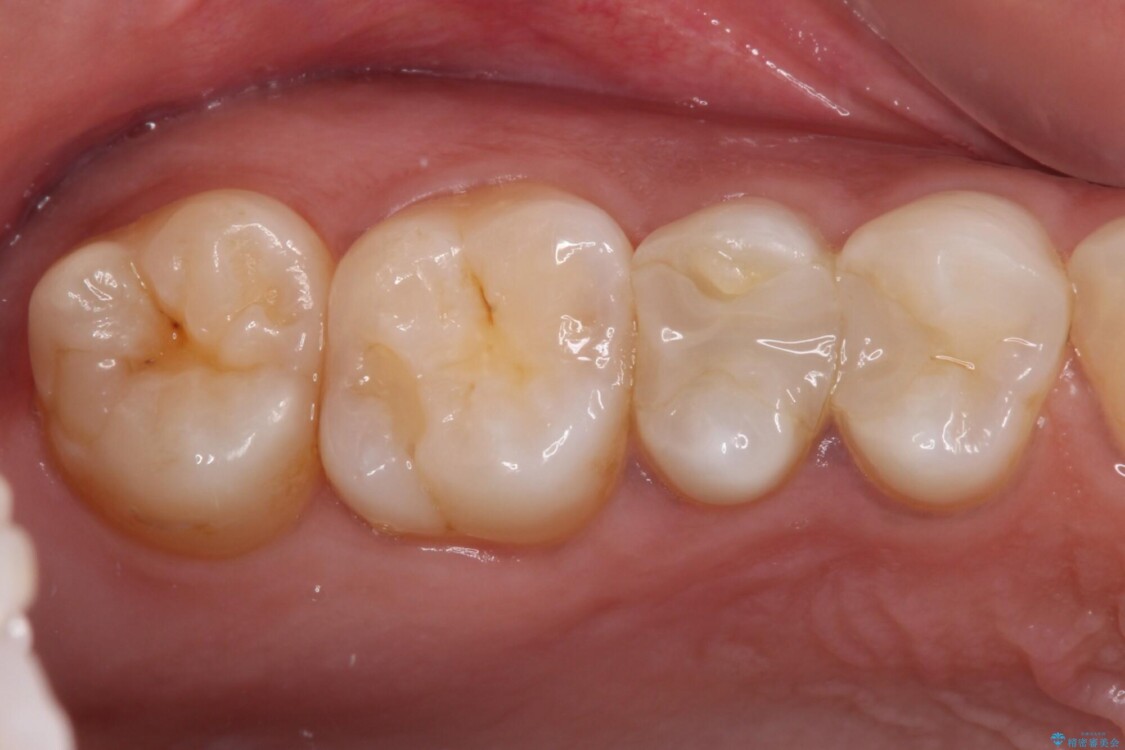 奥歯のむし歯をゴールドインレーで修復 治療前