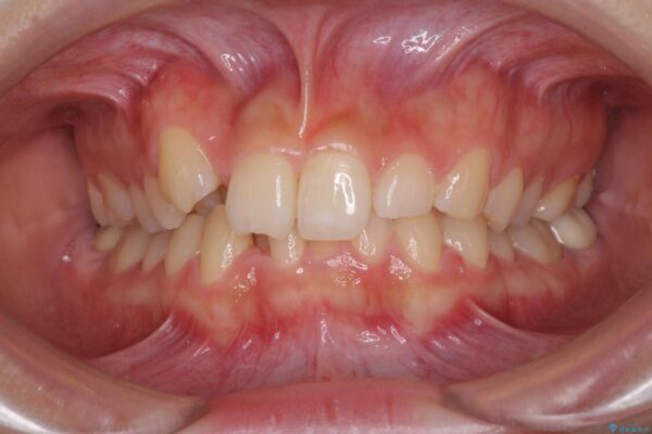 気になる八重歯を改善　補助装置併用のインビザライン治療 治療前画像