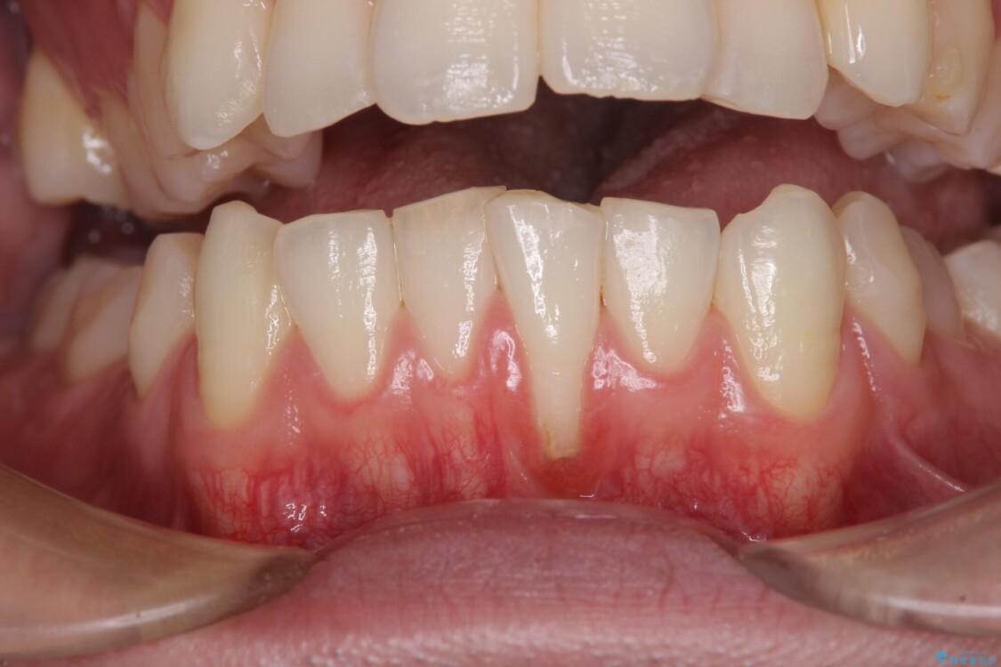 ほぼ歯根全てが露出　2度の歯肉移植術で自然な見た目に 治療前