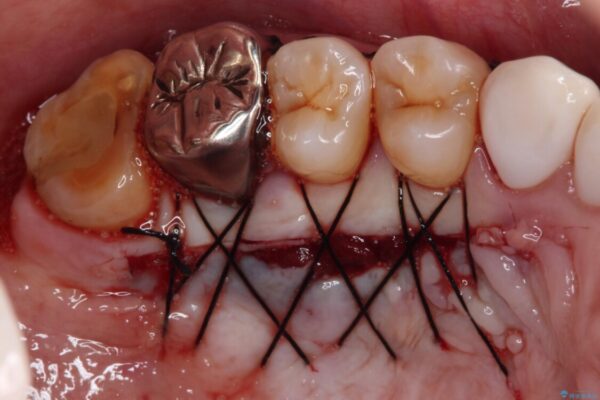 歯磨きの度にしみる歯　露出した歯根を歯肉移植で改善 治療前画像