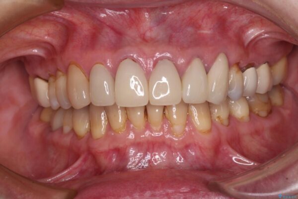 もげてしまった前歯をセラミッククラウンで自然に 治療後画像