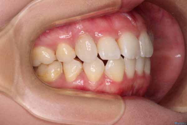 上顎の八重歯と下顎前歯の欠損　ワイヤー装置による抜歯矯正 治療後画像