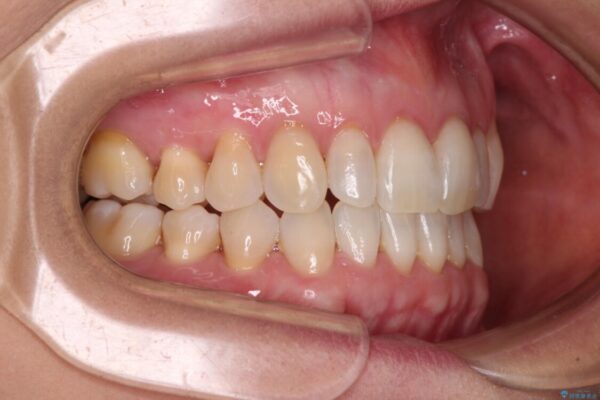 前歯のスペースが気になる　インビザラインによる矯正治療 治療後画像