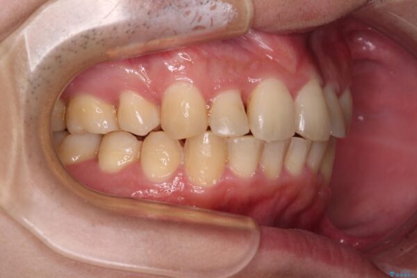 強い咬み込みですり減った前歯　デコボコを抜歯矯正で整える 治療後画像