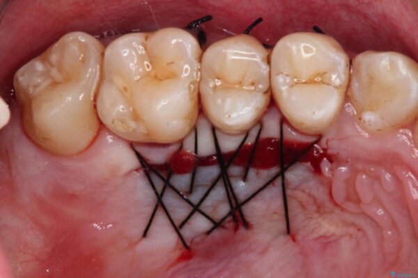 しみてしまう下顎の犬歯　歯肉移植による根面被覆 治療後画像