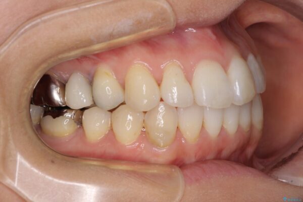 気になる前歯をインビザライン・ライトで　矯正治療後には銀歯をセラミックに 治療途中画像