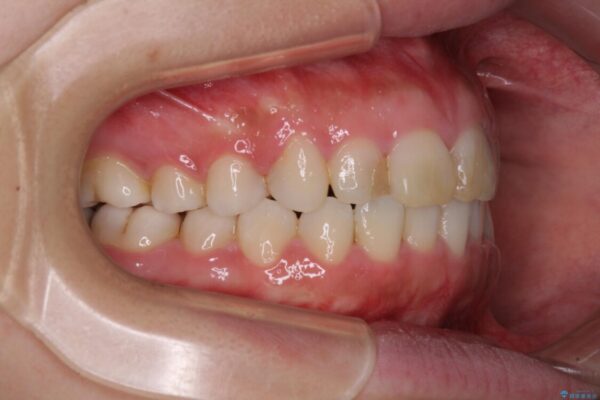 気になる前歯を治したい　インビザラインで気づかれずに矯正治療 治療途中画像
