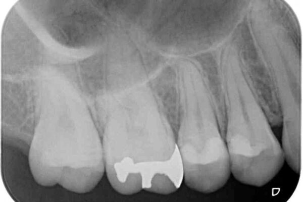 奥歯のむし歯をゴールドインレーで修復 治療後画像