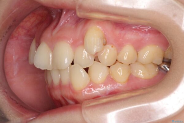 上顎の八重歯と下顎前歯の欠損　ワイヤー装置による抜歯矯正 治療前画像