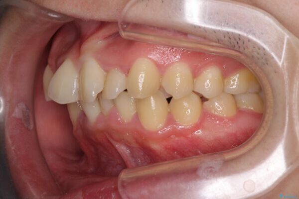強い咬み込みですり減った前歯　デコボコを抜歯矯正で整える 治療前画像