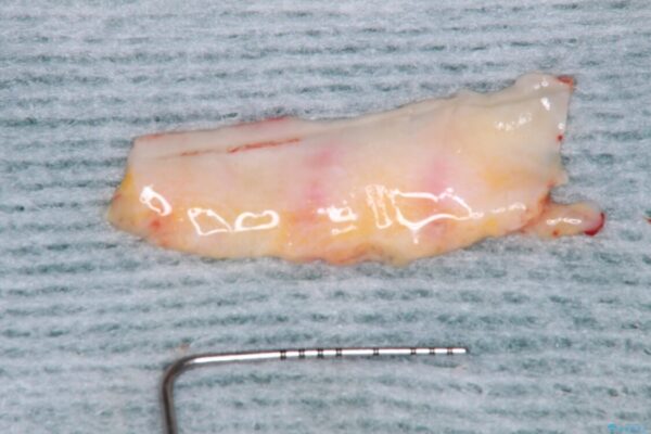下顎前歯の歯肉退縮　歯肉移植による根面被覆 治療途中画像