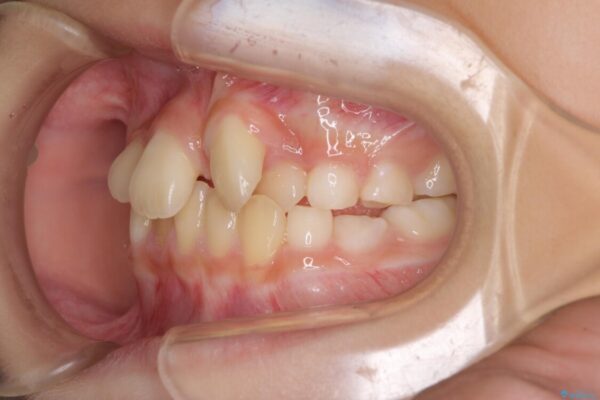 過剰歯を抜歯して前歯を排列　インビザライン・ファーストによる小学生のⅠ期治療 治療前画像