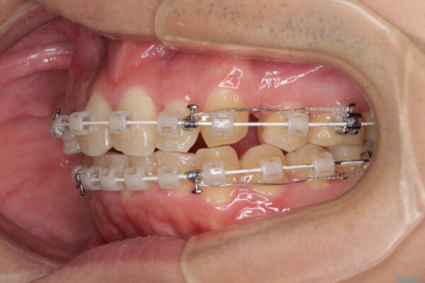 強い咬み込みですり減った前歯　デコボコを抜歯矯正で整える 治療途中画像