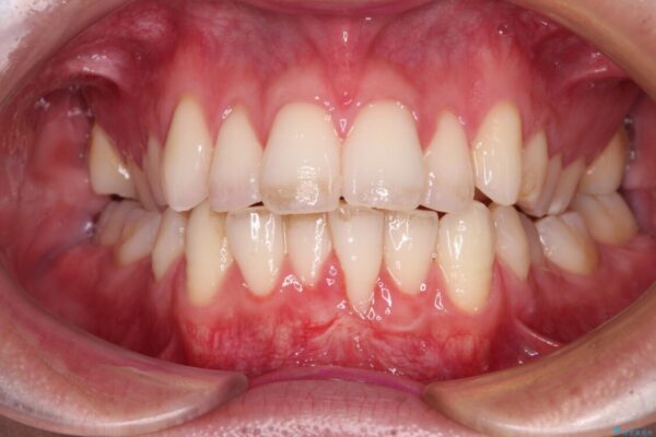 ほぼ歯根全てが露出　2度の歯肉移植術で自然な見た目に 治療前画像