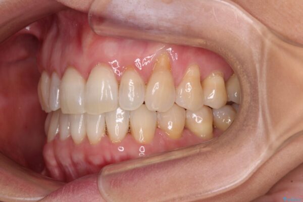 前歯のスペースが気になる　インビザラインによる矯正治療 治療前画像