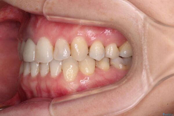 前歯のクロスバイトと治療が必要なむし歯　矯正とセラミックの総合歯科治療 治療後画像