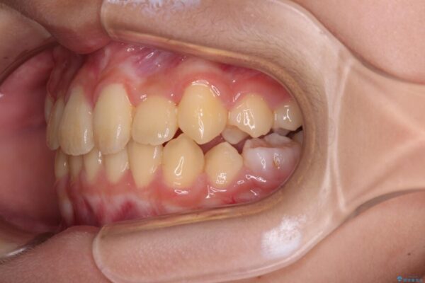 過剰歯を抜歯して前歯を排列　インビザライン・ファーストによる小学生のⅠ期治療 治療後画像
