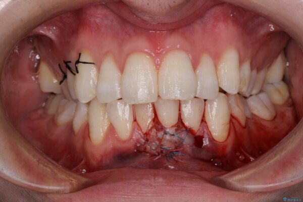 ほぼ歯根全てが露出　2度の歯肉移植術で自然な見た目に 治療途中画像