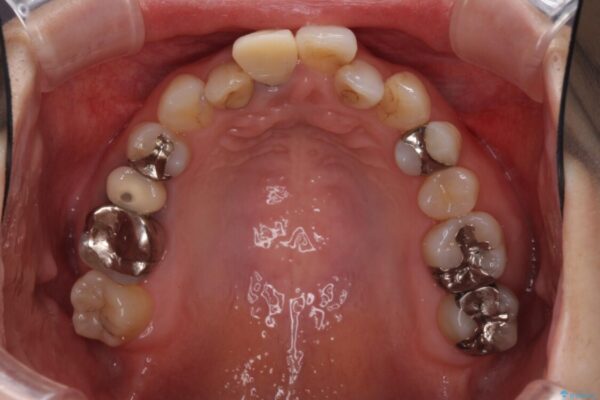 前歯のクロスバイトと治療が必要なむし歯　矯正とセラミックの総合歯科治療 治療前画像