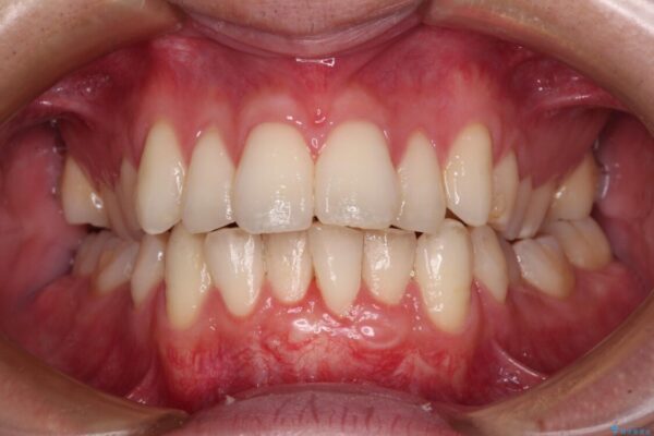 ほぼ歯根全てが露出　2度の歯肉移植術で自然な見た目に 治療後画像