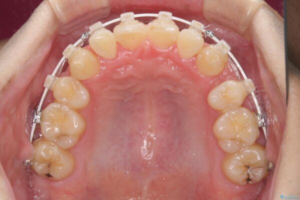 強い咬み込みですり減った前歯　デコボコを抜歯矯正で整える 治療途中画像