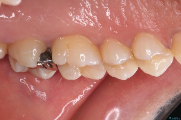 奥歯のむし歯をゴールドインレーで修復 治療前画像