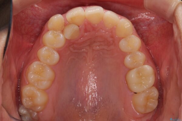 気になる八重歯を改善　補助装置併用のインビザライン治療 治療前画像