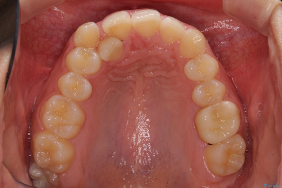 気になる八重歯を改善　補助装置併用のインビザライン治療 治療前