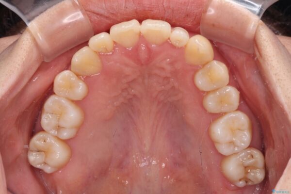 八重歯の抜歯矯正　補助装置を用いたインビザライン矯正 治療後画像