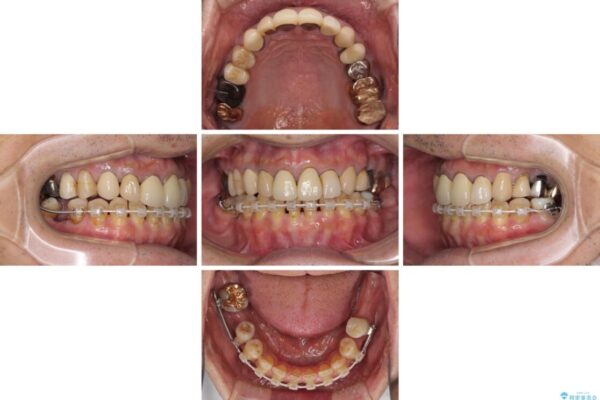 下顎の部分矯正を行ってから奥歯の補綴治療とインプラント治療 治療途中画像