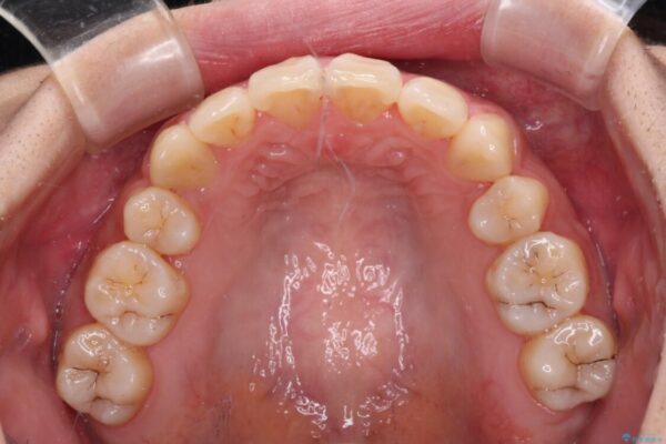 補助装置を使ったインビザラインによる抜歯矯正 治療後画像