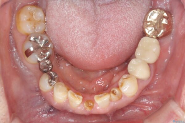 乳歯や矮小歯の多い前歯　部分矯正と補綴治療による審美歯科治療 治療途中画像