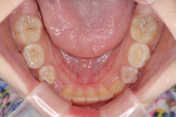 過剰歯を抜歯して前歯を排列　インビザライン・ファーストによる小学生のⅠ期治療 治療途中画像