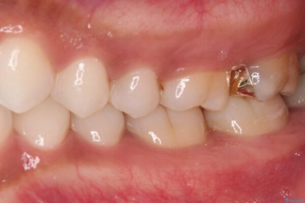 奥歯のむし歯をゴールドインレーで修復 治療後画像