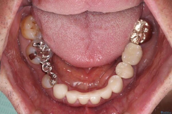 乳歯や矮小歯の多い前歯　部分矯正と補綴治療による審美歯科治療 治療後画像