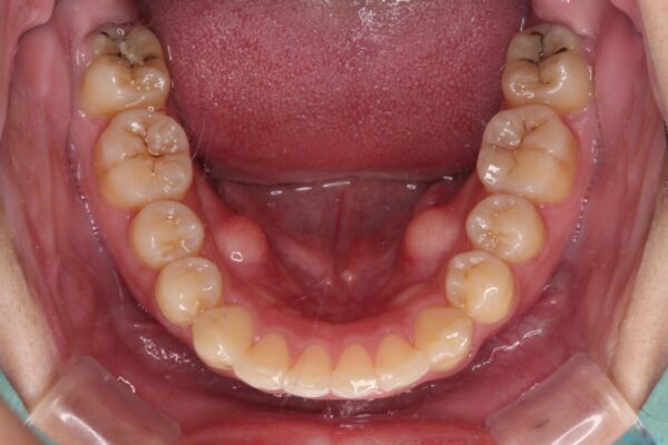 強い咬み込みですり減った前歯　デコボコを抜歯矯正で整える 治療後画像