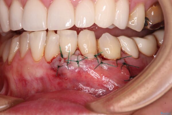 歯磨きの度にしみる歯　露出した歯根を歯肉移植で改善 治療途中画像