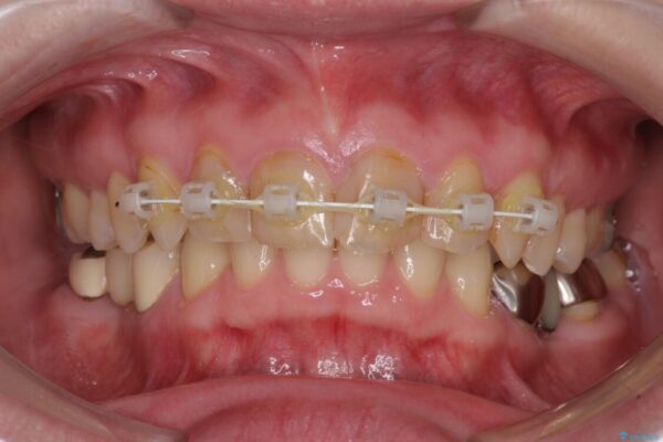 割れてしまった奥歯をインプラントで　気になる銀歯もセラミッククラウンで審美的に 治療途中画像