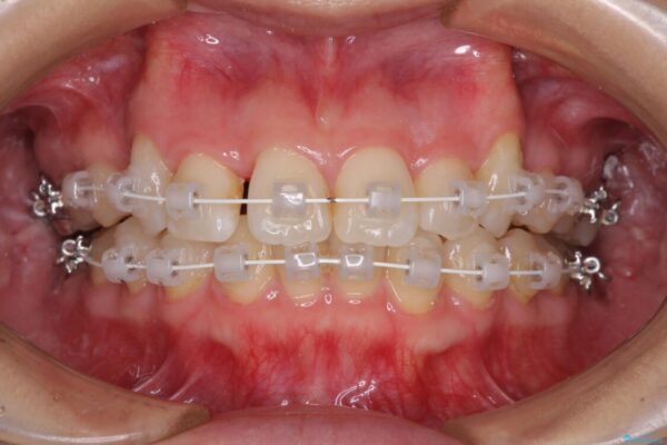 上顎の八重歯と下顎前歯の欠損　ワイヤー装置による抜歯矯正 治療途中画像