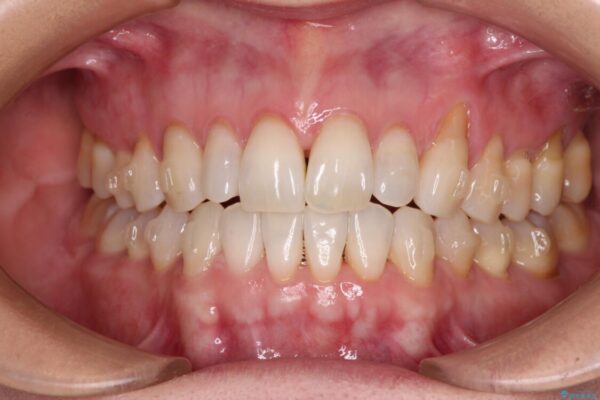 前歯のスペースが気になる　インビザラインによる矯正治療 治療途中画像