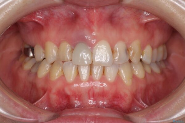 前歯のクロスバイトと治療が必要なむし歯　矯正とセラミックの総合歯科治療 治療途中画像