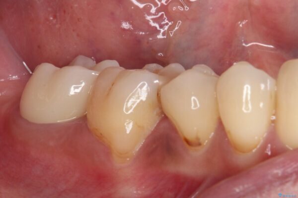 もげてしまった奥歯　部分矯正で清掃性の良い補綴治療 治療後画像