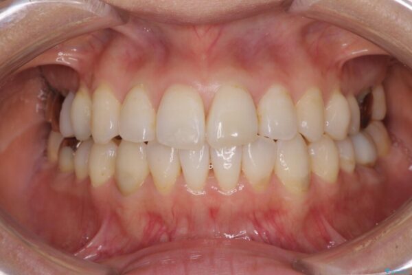 気になる前歯をインビザライン・ライトで　矯正治療後には銀歯をセラミックに 治療途中画像
