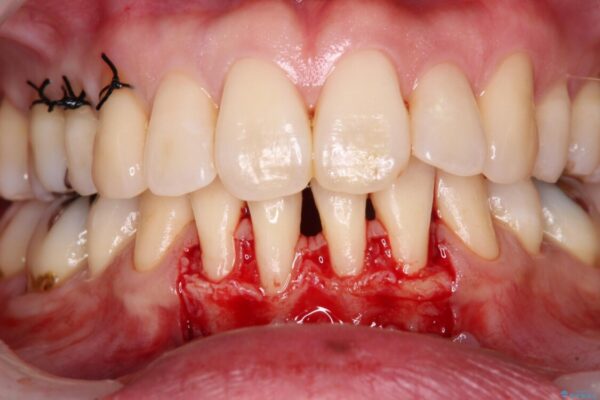 下顎前歯の歯肉退縮　歯肉移植による根面被覆 治療途中画像